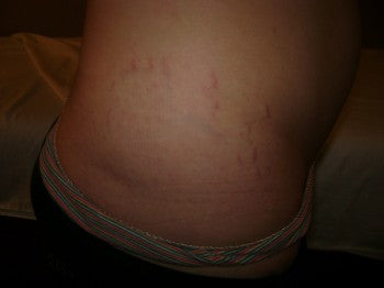 Tiger Stripes? Do you have stretch marks?